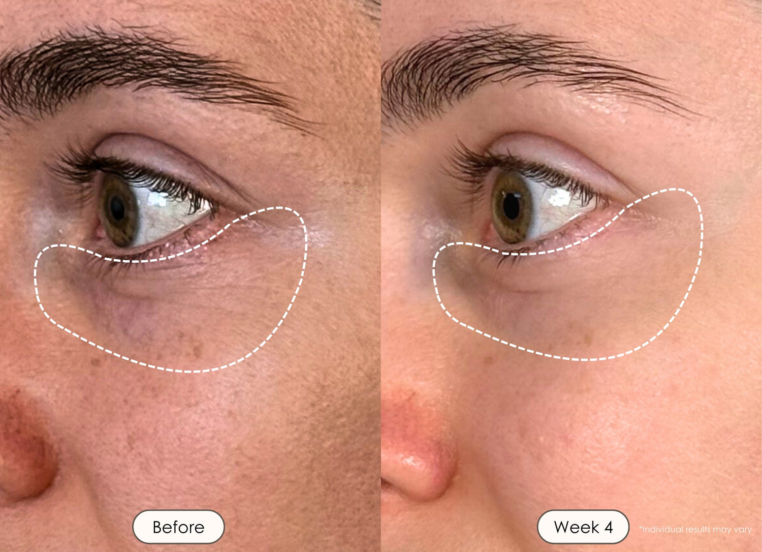 visible results after 4 weeks of using the LED light therapy mask