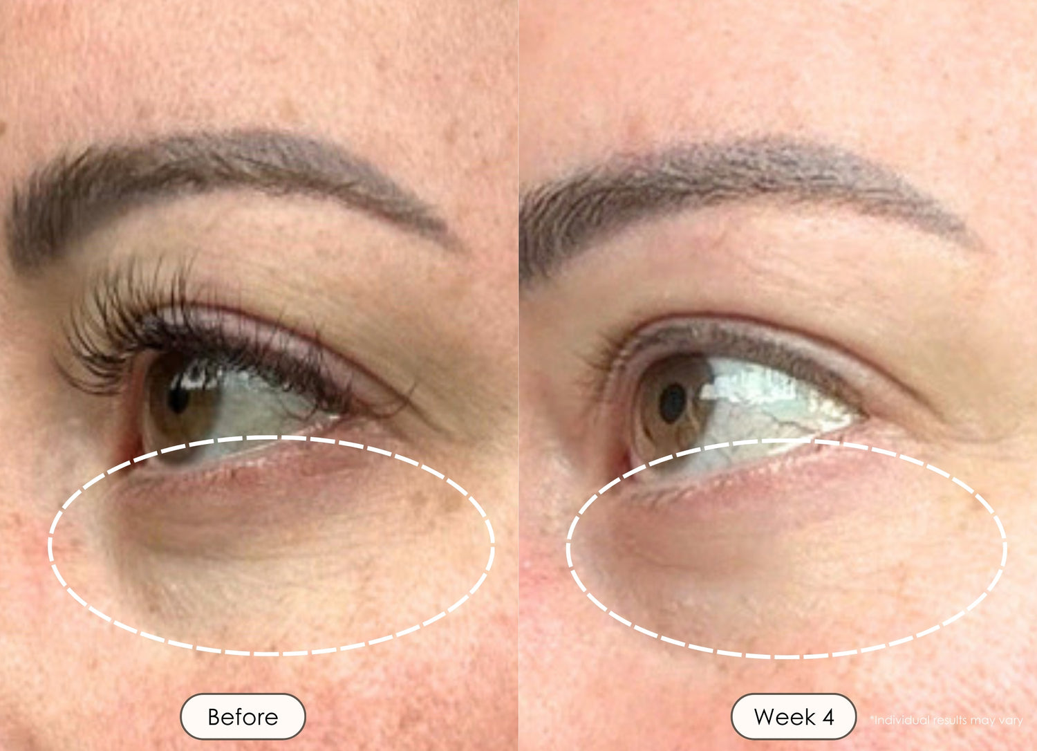 Close-up before and after comparison of forehead of a woman skin showing reduced redness and improved texture after 4 weeks of LED light therapy.