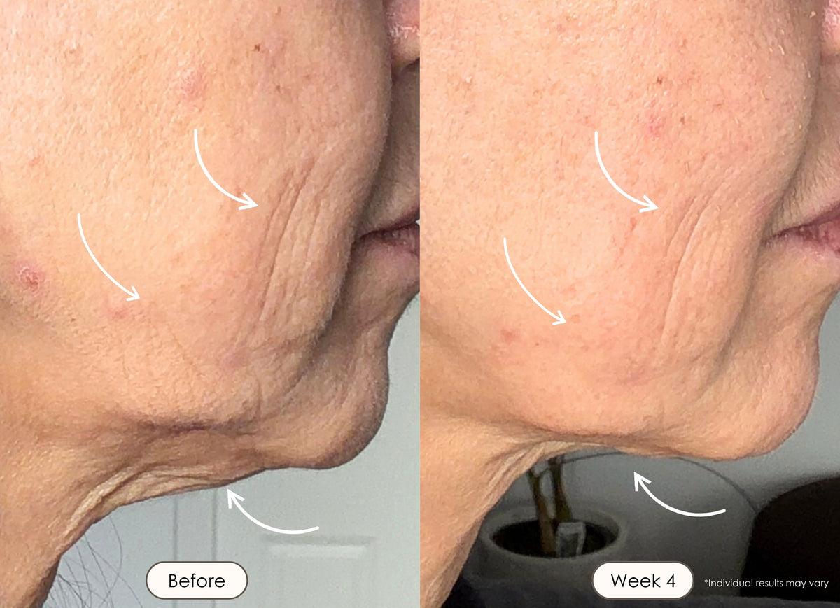 Woman showing smoother cheek and jawline skin after 4 weeks of using red led light therapy.