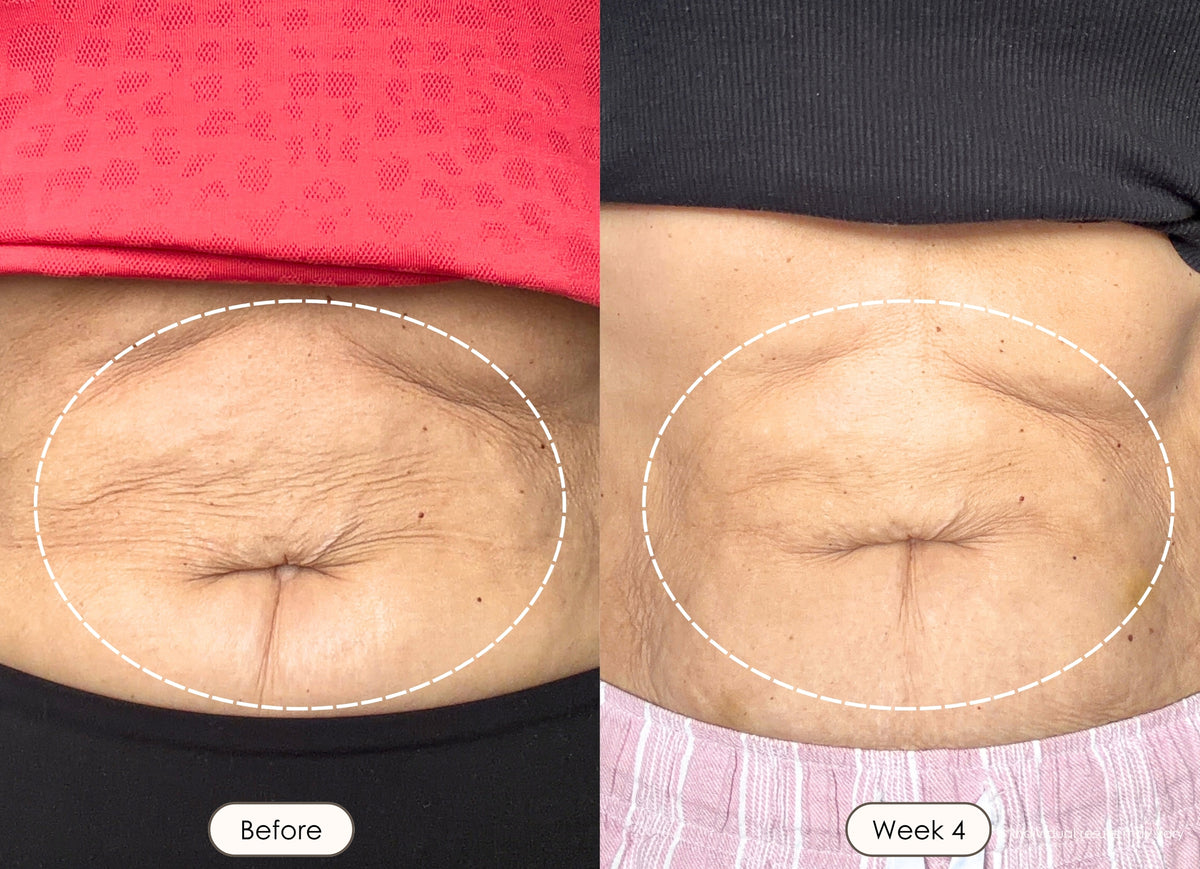 Woman showing smoother cheek and jawline skin after 4 weeks of using red led light therapy.