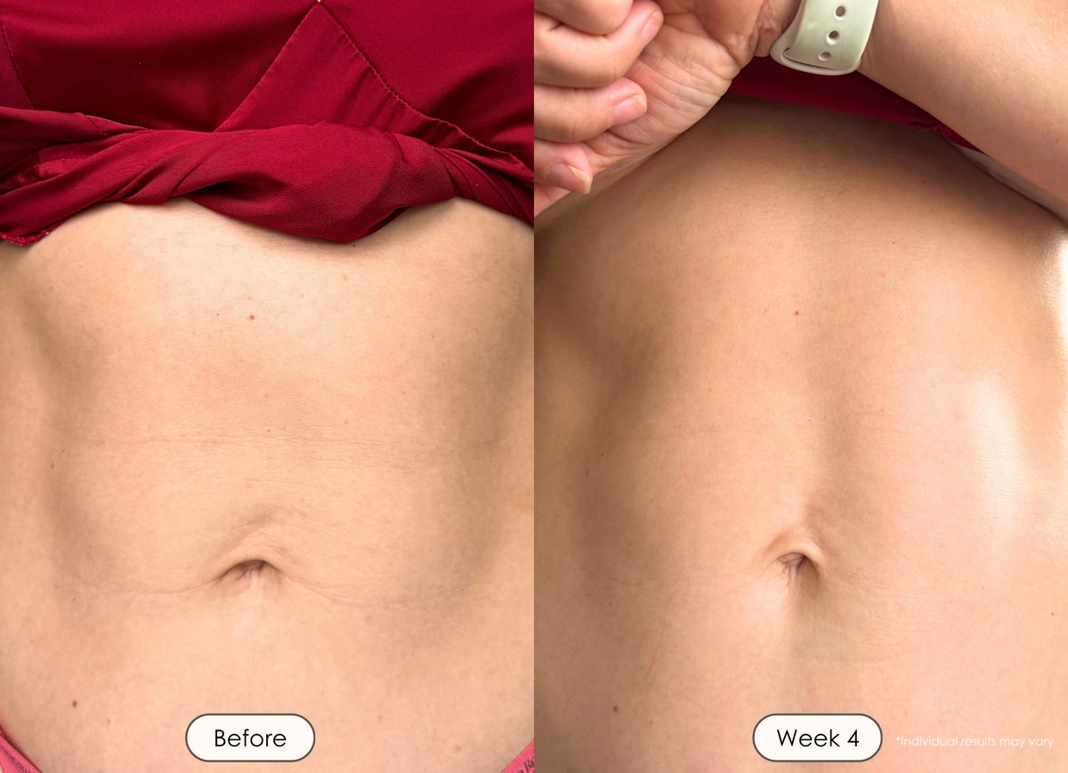 Woman showing belly skin improvement after 4 weeks of treatment.